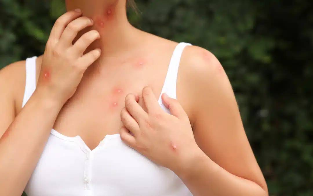 Comment se protéger des moustiques pendant l’été : Astuces et solutions